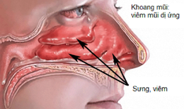 Dùng thuốc trị viêm mũi dị ứng: Giảm nhanh triệu chứng, nhưng cần dùng đúng cách