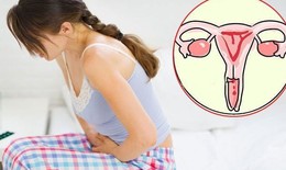 Ung thư cổ tử cung: Phòng bệnh từ hôm nay để bảo vệ ngày mai