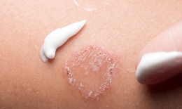 Dấu hiệu nổi bật của bệnh lác đồng tiền và cách xử trí