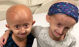 Trẻ nhỏ gi&#224; đi như người gi&#224; do b&#237; ẩn gen lỗi trong hội chứng Progeria