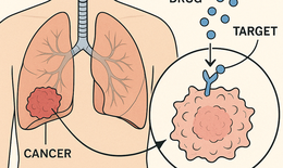 C&#225;ch ph&#225;t hiện sớm ung thư phổi