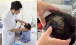 Ng&#227; cầu thang trong l&#250;c chơi, b&#233; 3 tuổi bị vỡ xương sọ, tụ m&#225;u ngo&#224;i m&#224;ng cứng