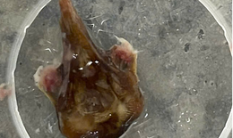 Hai bệnh viện phối hợp gắp mảnh xương cá, giúp cụ bà 84 tuổi cai máy thở