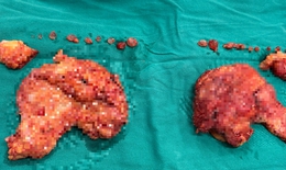 Cấp cứu bệnh nhân HIV gặp biến chứng khi thẩm mỹ tại cơ sở “chui”