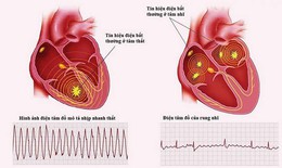 Tại sao rung nhĩ lại nguy hiểm?