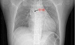 Vừa xem tivi vừa chơi, b&#233; 13 tuổi nuốt đinh ghim v&#224;o đường thở
