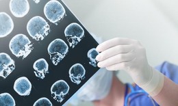 Người trẻ đối mặt với gánh nặng kép của đột quỵ não và sa sút trí tuệ