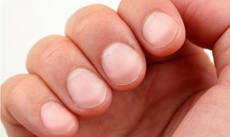 5 dấu hiệu tr&#234;n m&#243;ng tay c&#243; thể tiết lộ t&#236;nh trạng sức khỏe của người nhiễm HIV