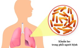 Hiểu về bệnh HIV tiến triển: Nguy cơ v&#224; c&#225;ch quản l&#253; hiệu quả