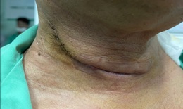 Ph&#225;t hiện mắc c&#249;ng l&#250;c 2 loại ung thư sau 6 th&#225;ng kh&#224;n tiếng