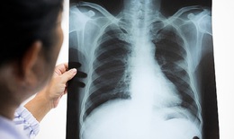 Bất ngờ ph&#225;t hiện ung thư phổi khi đi kh&#225;m sức khoẻ định kỳ
