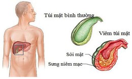 Dấu&#160;hiệu&#160;của&#160;vi&#234;m&#160;t&#250;i&#160;mật&#160;theo&#160;từng&#160;giai&#160;đoạn