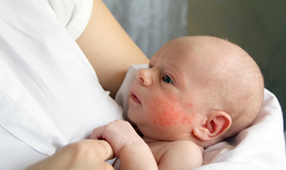 Trẻ em hay mắc c&#225;c bệnh dị ứng n&#224;o?