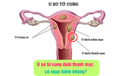 U xơ tử cung dưới thanh mạc có nguy hiểm không?