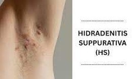 Thuốc trị viêm tuyến mồ hôi mủ