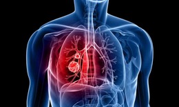 T&#236;nh trạng vi&#234;m c&#243; thể g&#226;y khởi ph&#225;t ung thư phổi ở giai đoạn sớm