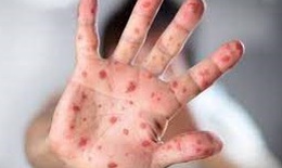 Cảnh gi&#225;c với nguy cơ bệnh sởi &#39;trở lại to&#224;n cầu&#39;