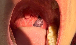 Lấy khối u m&#225;u hiếm gặp trong họng bệnh nhi