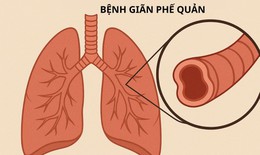 Ho ra m&#225;u&#160;cần cảnh gi&#225;c với&#160;gi&#227;n phế quản