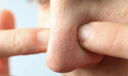 5 loại mặt nạ trị mụn đầu đen từ nguyên liệu nhà bếp giúp da mịn sạch tự nhiên