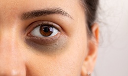 9 loại thực phẩm hỗ trợ sản xuất collagen làm mờ quầng thâm mắt tự nhiên