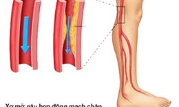 Bệnh động mạch chi dưới ở người cao tuổi dễ nặng lên vào mùa lạnh
