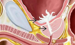 Không thấy tinh dịch sau quan hệ cảnh báo xuất tinh ngược