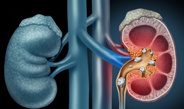  C&#225;ch điều trị bệnh sỏi thận đ&#250;ng cần biết