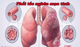Nhận biết bệnh&#160;phổi&#160;tắc&#160;nghẽn&#160;mạn&#160;t&#237;nh