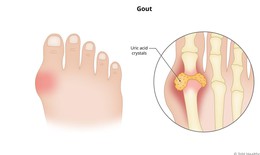 Thiếu vitamin D c&#243; thể g&#226;y tăng axit uric