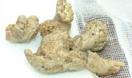 Sỏi san h&#244; trong thận l&#224; g&#236;, c&#243; nguy hiểm kh&#244;ng?