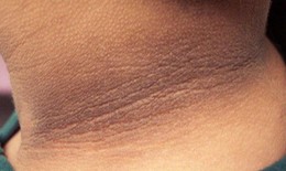 Bệnh gai đen xảy ra do nguyên nhân nào?