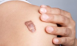 Chữa sẹo lồi c&#243; kh&#243; kh&#244;ng?