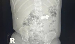 B&#233; trai nuốt 4 vi&#234;n đinh nam ch&#226;m đầu nhọn nguy hiểm
