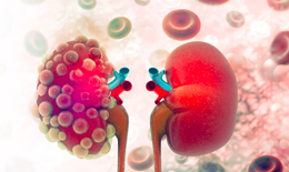 Đau lưng k&#233;o d&#224;i, người đ&#224;n &#244;ng 60 tuổi ph&#225;t hiện ung thư thận hiếm gặp