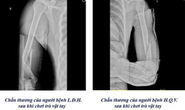 Cảnh báo nguy cơ gẫy xương cánh tay từ trò vật tay