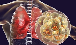 4 triệu chứng điển h&#236;nh cảnh b&#225;o mắc vi&#234;m phổi