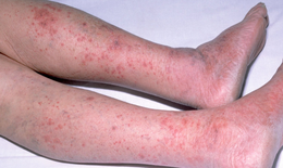 Vi&#234;m n&#227;o m&#244; cầu: Căn bệnh nguy hiểm c&#243; thể g&#226;y tử vong trong 24 giờ xuất hiện tại H&#224; Nội