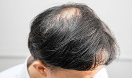 Rụng tóc nhiều vào mùa đông: Bác sĩ chỉ 3 sai lầm khi gội sấy và 4 cách khắc phục