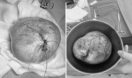 Phenikaa phẫu thuật thành công cho bé gái 9 tuổi mắc u quái buồng trứng 20 cm, bảo toàn khả năng sinh sản