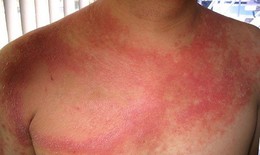 Biến&#160;chứng&#160;nguy hiểm của&#160;lupus ban&#160;đỏ&#160;hệ&#160;thống