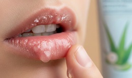 Gợi ý 8 biện pháp khắc phục tại nhà cho môi khô và nứt nẻ