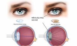 Dấu hiệu điển h&#236;nh nhận biết đục thủy tinh thể