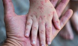 Dịch sởi b&#249;ng ph&#225;t mạnh tại Mỹ, h&#224;ng trăm trẻ em phải c&#225;ch ly