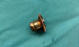 Cụm pin cúc áo trong thực quản bé trai 2 tuổi