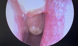 Phẫu thuật thành công cho bệnh nhân polyp mũi hai bên, viêm mũi xoang kèm hàng loạt bệnh lý nền nặng 