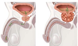 Phì đại tuyến tiền liệt lành tính khi nào nguy hại?