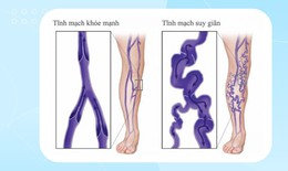 Thuốc và phương pháp điều trị suy tĩnh mạch chi dưới mạn tính