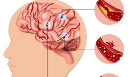 Bệnh nhân 87 tuổi hôn mê sâu do xuất huyết não, cảnh báo nguy cơ và cách phòng ngừa căn bệnh nguy hiểm
