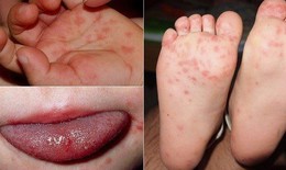 Bệnh tay ch&#226;n miệng d&#249;ng thuốc như thế n&#224;o?